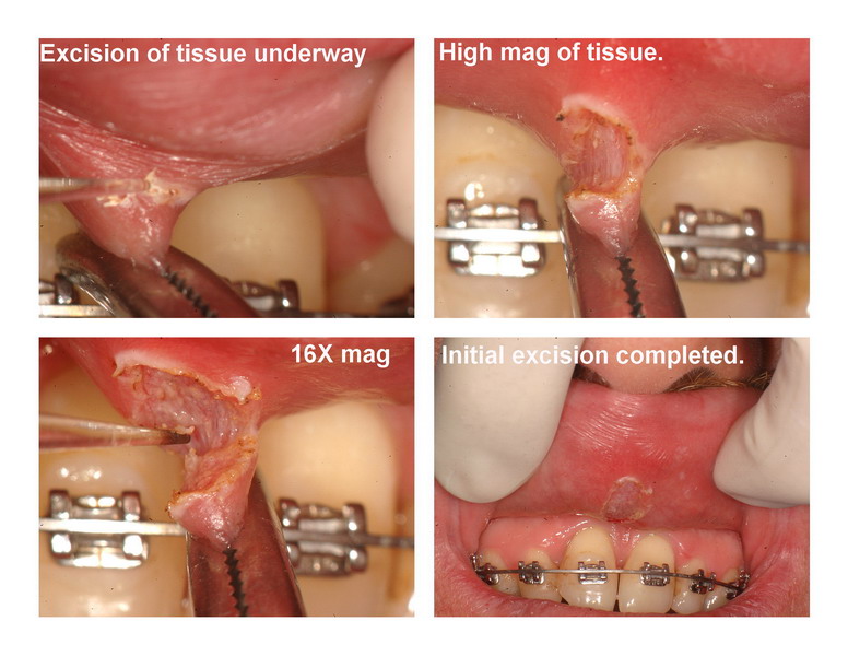 JP frenectomy edited pg 2_resize.jpg